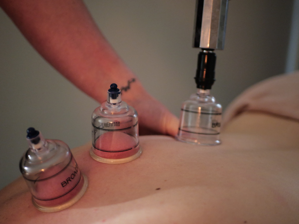 Cupping Therapy